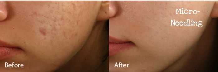 Microneedling
