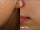 Microneedling Image 3