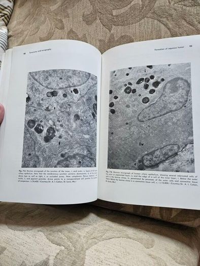 Beckers- Shaffer's Diagnosis And Therapy Of The Glaucomas. By Allan E. Kolker & John Hetherington,jr. Large Volume Hardback In Good Condition. See Photos For Same.