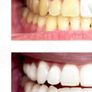 Laser Teeth Whitening D15 Image 6