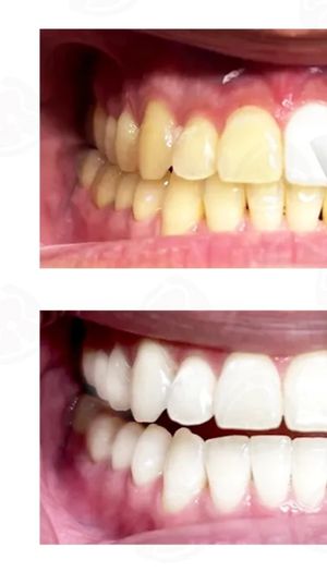 Laser Teeth Whitening D15