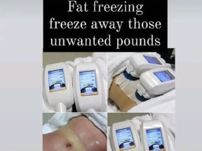 fat freeze machine