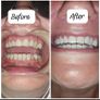 Teeth whitening in comfort of your own home Image 5