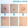Skin Tags Removal Kit Painless Skin Tags Remover Pen Easy Skin Tags Remover Device To Remove 4mm-9mm Skin Tags Effective For Image 2