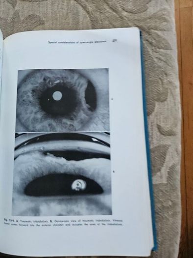 Beckers- Shaffer's Diagnosis And Therapy Of The Glaucomas. By Allan E. Kolker & John Hetherington,jr. Large Volume Hardback In Good Condition. See Photos For Same.