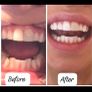Teeth whitening in comfort of your own home Image 3