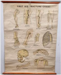1942 First Aid fracture chart