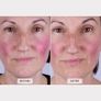 Led Face Mask (brand New) Image 8