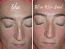 Dermaplaning Image 6