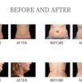 Fat melting -  ultrasound cavitation/radiofrequency/lymphatic drainage machine Image 4