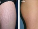 Microneedling Image 2
