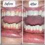 Teeth whitening in comfort of your own home Image 4