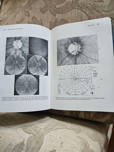 Beckers- Shaffer's Diagnosis And Therapy Of The Glaucomas. By Allan E. Kolker & John Hetherington,jr. Large Volume Hardback In Good Condition. See Photos For Same.