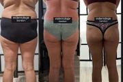 Emsculpt slimming toning machine