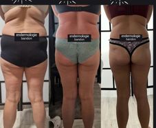 Emsculpt slimming toning machine