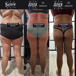 Emsculpt slimming toning machine