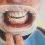 Laser Teeth Whitening D15 Image 4