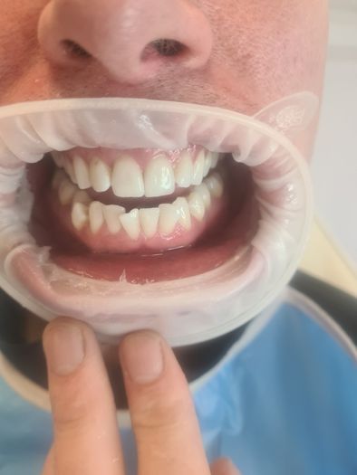 Laser Teeth Whitening D15