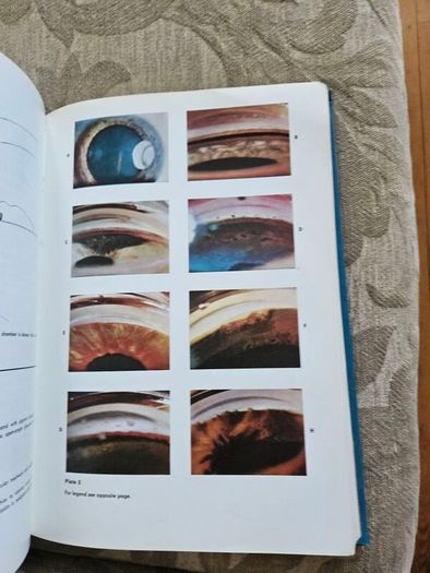 Beckers- Shaffer's Diagnosis And Therapy Of The Glaucomas. By Allan E. Kolker & John Hetherington,jr. Large Volume Hardback In Good Condition. See Photos For Same.