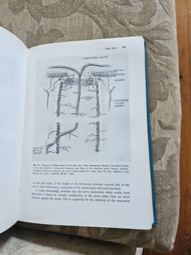 Beckers- Shaffer's Diagnosis And Therapy Of The Glaucomas. By Allan E. Kolker & John Hetherington,jr. Large Volume Hardback In Good Condition. See Photos For Same.