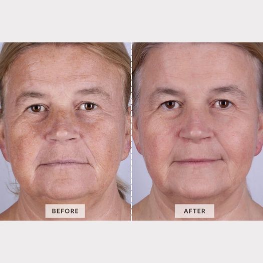 Led Face Mask (brand New)