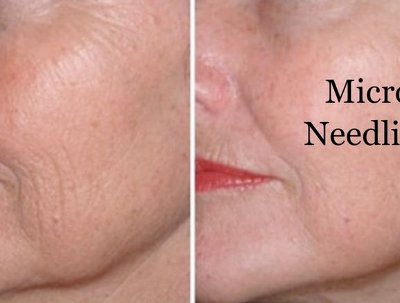 Microneedling
