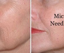 Microneedling