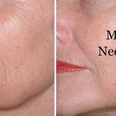Microneedling