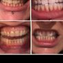 Teeth whitening in comfort of your own home Image 6
