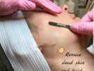 Dermaplaning Image 3